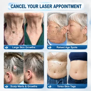 𝐎𝐟𝐟𝐢𝐜𝐢𝐚𝐥 𝐁𝐫𝐚𝐧𝐝 𝐒𝐭𝐨𝐫𝐞 |✅💎Hiskin ® 7-𝐷𝑎𝑦 𝗧𝐚𝐠 & 𝗦𝗽𝐨𝐭 𝐄𝐫𝒂𝒔𝒆𝒓(Zero Pain, Ze
 – CareUplift®
